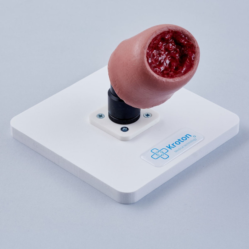 Surgical removal of uterine leiomyomas Surgical removal of uterine leiomyomas