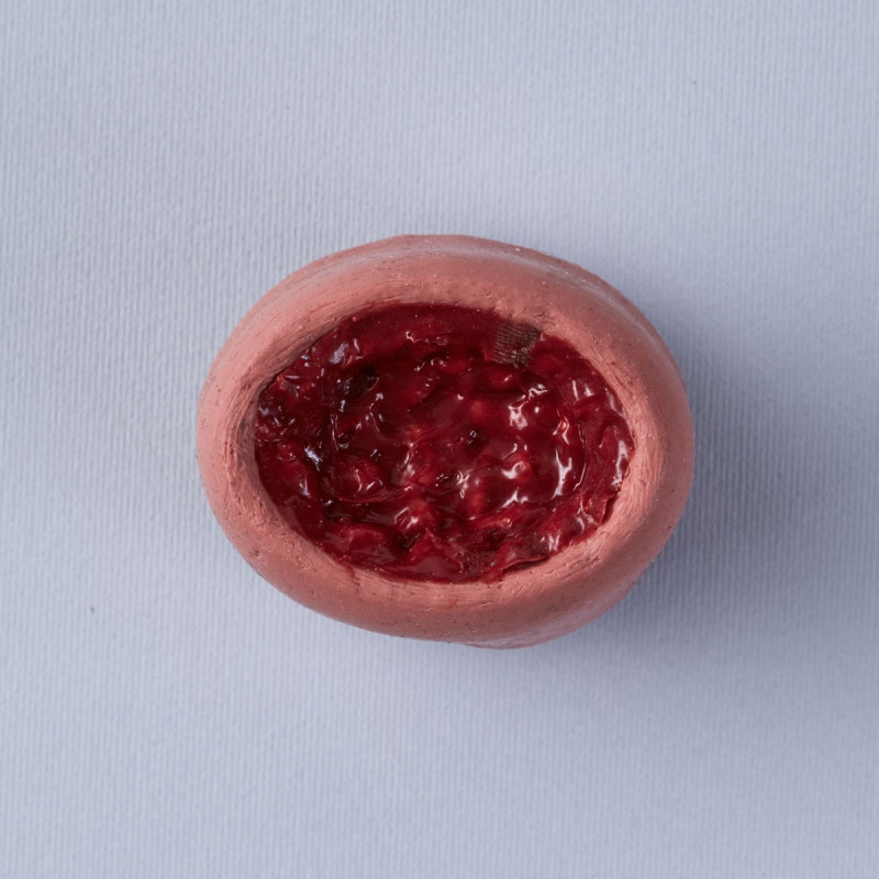 Surgical removal of uterine fibroids Surgical removal of uterine fibroids