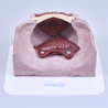 Anastomosis after radical prostatectomy (URO001)